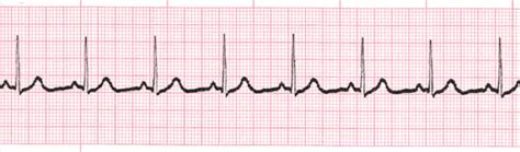 Normal Sinus Rhythm .